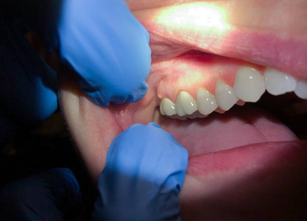 Best Emergency Dental Filling Replacement  in Carencro, LA