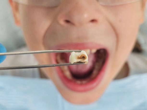 Best Chipped Tooth Repair Near Me  in Carencro, LA